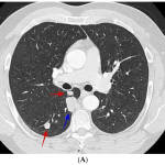 JoF  Free Full Text  Differentiating Lung Nodules Due To